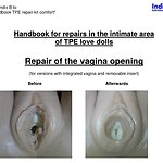 Appendix B - Repair of the vagina opening - Indigo Individual TPE Repair Kit ›co