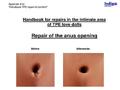Appendix A - Repair of the anus opening - Indigo Individual TPE Repair Kit ›comf