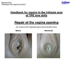 Appendix B - Repair of the vagina opening - Indigo Individual TPE Repair Kit ›co